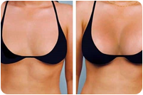augmenatation taille poitrine