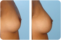 augmenatation taille seins
