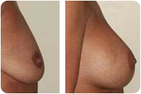 raffermissement seins affaissés